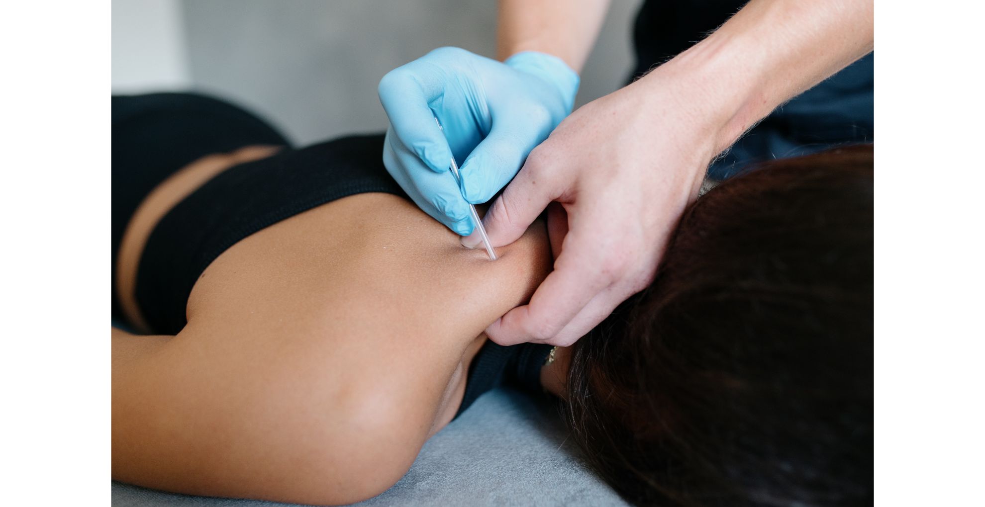 Dry needling